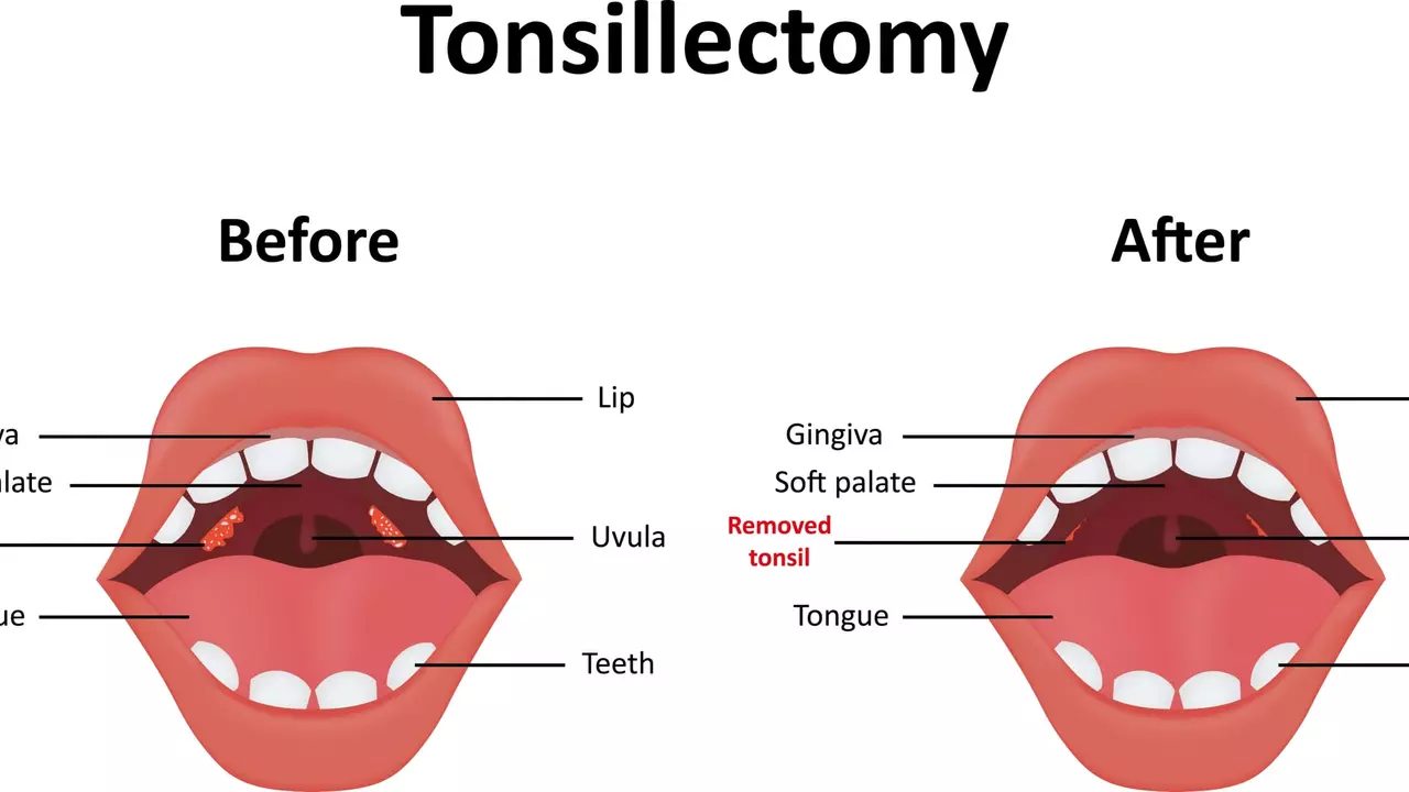 tonsillitis-in-babies-what-parents-need-to-know